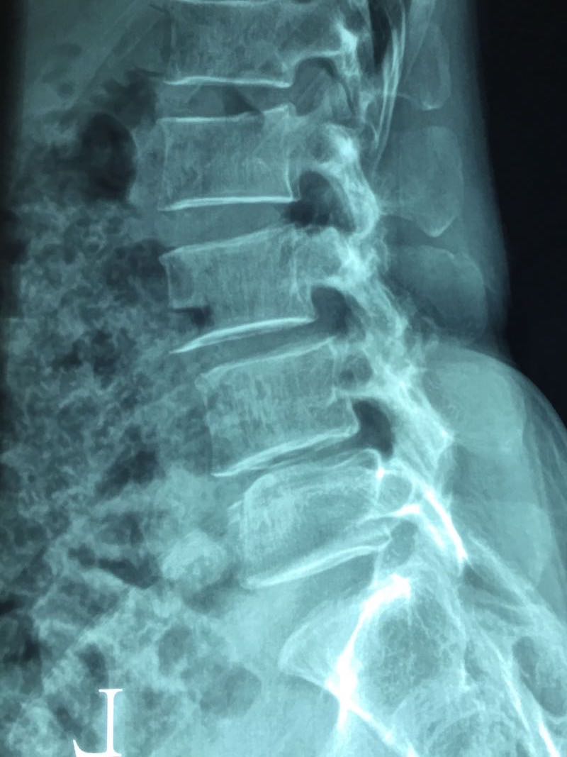 Upright lateral spinal X-ray showing vertebrae, disc spaces and alignment